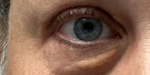 Xanthelasma