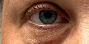 Xanthelasma