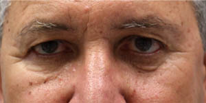 Blepharoplasty