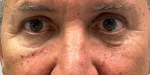 Blepharoplasty