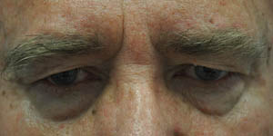 Blepharoplasty