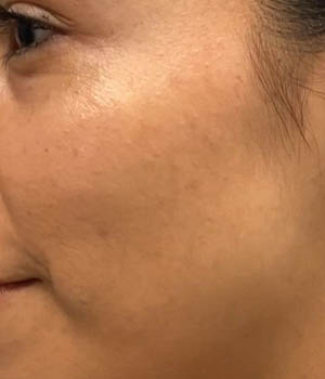 IPL PhotoFacial