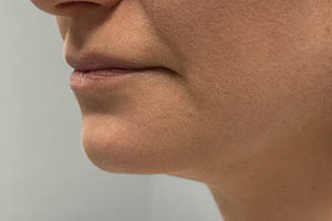 Dermal Fillers