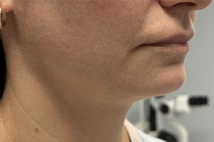 Dermal Fillers