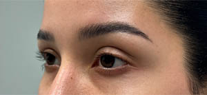 Ptosis Repair