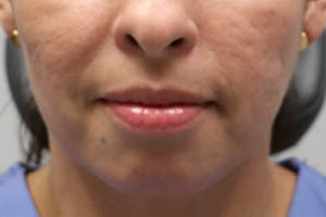 Dermal Fillers