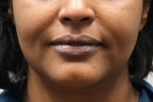 Dermal Fillers