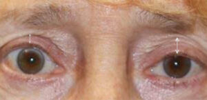 Ptosis Repair