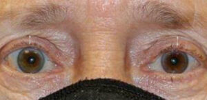 Ptosis Repair