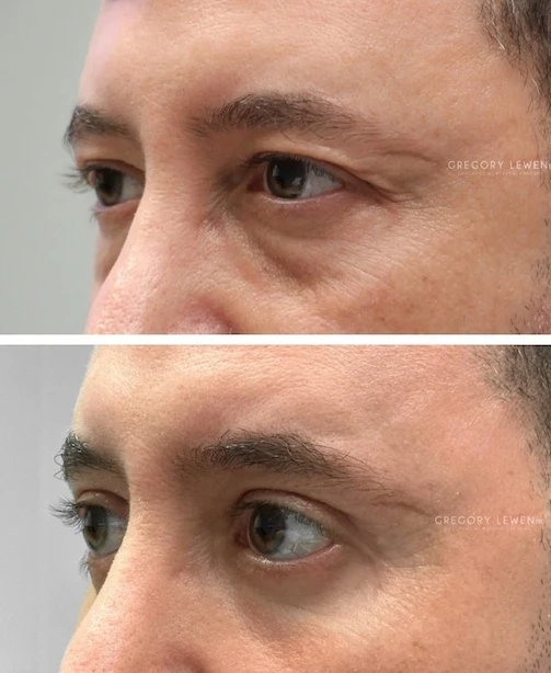 before and after surgery pictures | Top Miami Surgeon Gregory D. Lewen, MD