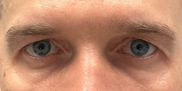 1_0002_PT 50– before upper bleph with direct brow lift and subbrow filler (front).jpg