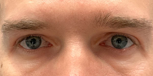 1_0003_PT 50– after upper bleph with direct brow lift and subbrow filler(front).jpg