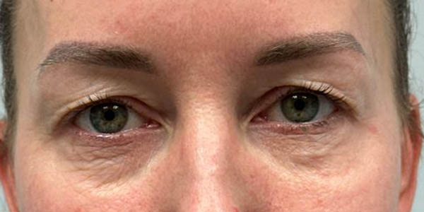 1_0006_PT 45 before — EYES ONLY– upper and lower bleph with facial fat grafting, peri-orbital CO2 laser, temporal brow