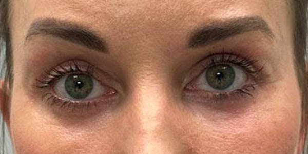 1_0007_PT 45 after — EYES ONLY– upper and lower bleph with facial fat grafting, peri-orbital CO2 laser, temporal brow